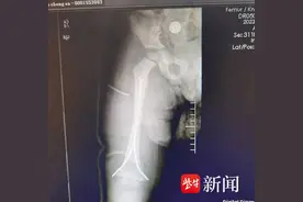 2岁娃娃遭电动三轮车碾压，右大腿能否完美保住图片