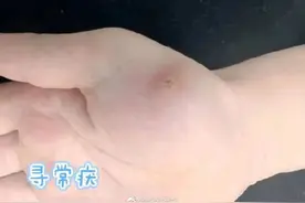 孩子身上长小疙瘩可能是感染HPV图片