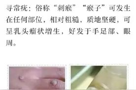 身上长的疣一碰会被传染吗？图片