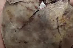 男子晒“术后取出颅骨碎片”冲上热搜！网友求科普，专家解答了图片
