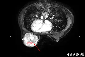 才16岁！宁波少女被查出巨大肿瘤，医生都惊了！其实早有症状……图片