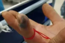 手指都黑了！海南一男子逗弄毒蛇被咬，6小时才送医！图片