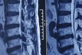 年纪大腰疼腿痛是常事？微创椎间孔镜解难题图片