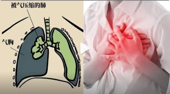 肺部竟然“炸”了？多位明星曾中招→