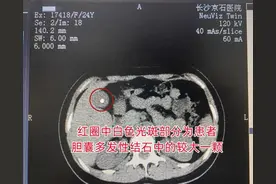 新手妈妈喝了一碗汤却住进了医院，检查才知竟是胆囊结石在作怪图片
