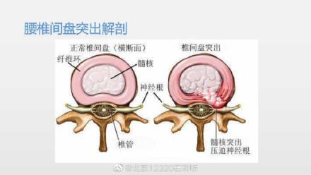 腰椎间盘膨出的治疗（一起了解腰椎间盘突出症的康复治疗）