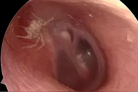 520露营、野餐提醒：小昆虫不慎进入耳朵，别掏、别拍！图片