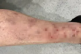 近期这种“巨痒”的皮肤病高发，接触流浪小动物要当心图片