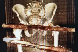 突发！危急！钢筋贯穿身体，7小时生死营救图片