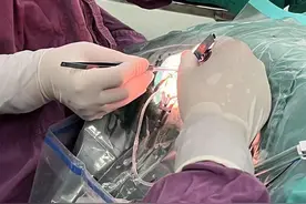 中部首例国产领扣型人工角膜移植术实施图片