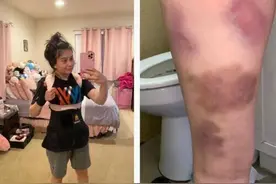 美国22岁女子身患多种疾病 一天晕厥十多次图片