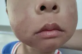 “再给孩子买芒果就离婚！”小孩爱吃芒果引发家庭矛盾，过敏后怎么办？图片