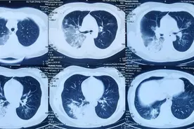 西安又发现1例“鹦鹉热”确诊病例！注意图片