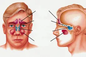 鼻窦炎让孩子苦不堪言！家长需要重视！图片