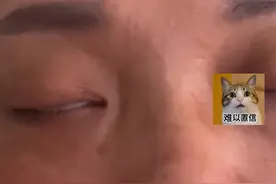 哈尔滨一女子花3000元割眼袋：眼睛3个月闭不合，一洗脸就进水图片