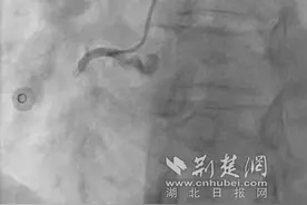 电除颤22次与死神抢人！医护“鬼门关”拉回心梗患者图片