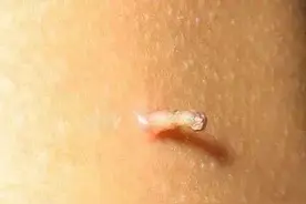 脖子上的小肉粒，说明身体出了问题！图片