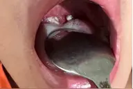 咽痛、发热、扁桃体上全是脓，抗菌素治疗却没效，这样的误诊很常见但其实很容易避免！图片