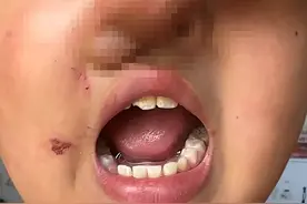 山东一小学生身体多处发现针眼淤青遍布？教育局：已成立调查组图片