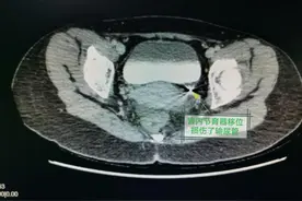 女子漏尿一个月，“罪魁祸首”竟是节育器移位图片