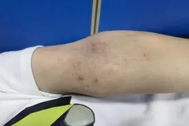 剧烈瘙痒！台州17岁男孩没睡过一个整觉！没想到问题竟出在……图片