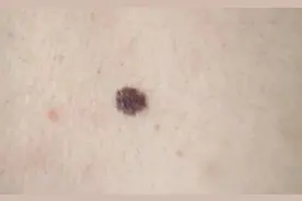 【科普】身上的“痣”不要乱扣 掌握ABCDE原则 教你判断图片