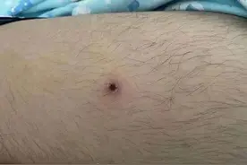 厦门11岁男孩公园玩耍后高烧40℃，脓毒性休克！只因被蚊虫叮咬图片