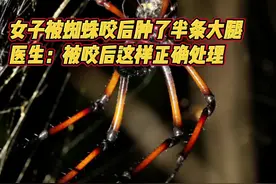 女子被蜘蛛咬后肿了半条大腿，医生：被咬后这样正确处理图片