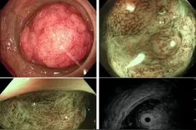 患者肠道检出鸡蛋般巨大息肉，专家提醒警惕息肉癌变图片