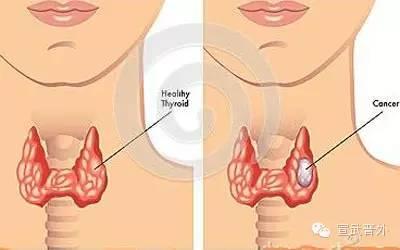 怎么判断自己有没有甲状腺 2026年怎么判断自己有没有甲状腺疾病