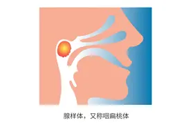 家有“呼噜娃”要留意！警惕孩子腺样体肥大图片