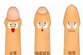 暑假到了，要不要给男孩割包皮？听听妇幼医生怎么说图片