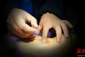 盛夏“减肥热”来袭丨穴位埋线疗法   助力健康减重图片