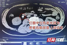 男子酷爱打牌常久坐憋尿 不料豌豆大结石堵住尿路引发剧痛图片