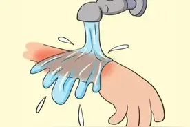 烫烧伤后怎么办？不要相信“偏方”，记住5字口诀！ | 健康总动员图片