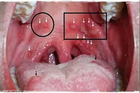 暑期即将来临，儿童疱疹性咽峡炎防治看这6招图片