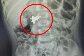 南宁4岁男童误吞金属玩具飞机紧急送医，48小时后飞机“着陆”！图片