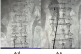 株洲市人民医院成功开展首例下腔静脉滤器植入术图片