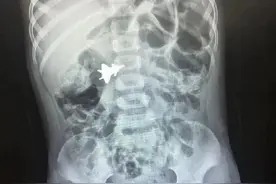 广西4岁男孩吞下歼-20模型！拍片可见玩具飞机在肚子里“飞”……图片