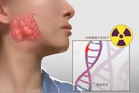 腮腺肿瘤新术式：耳后小切口切除，兼顾美容和治疗图片