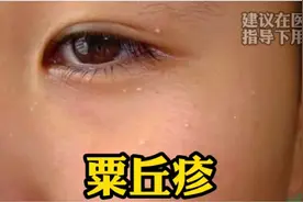眼周长了小疙瘩？如果是这样的，可能和疾病有关……图片
