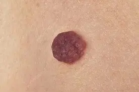 高能预警，黑痣来袭图片