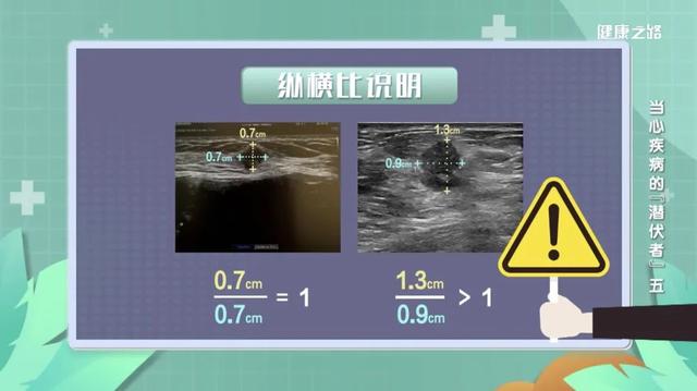别慌！乳腺结节不一定会恶化，具体要看这几点！