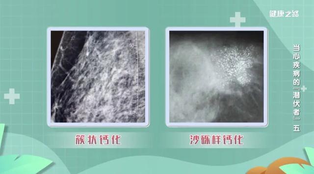 别慌！乳腺结节不一定会恶化，具体要看这几点！