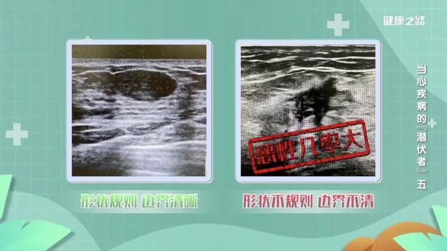 别慌！乳腺结节不一定会恶化，具体要看这几点！