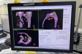 云南省肿瘤医院开展4D-CBCT图像引导联合Body-Fix体位固定等多项放疗新技术图片