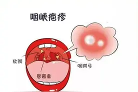 杭州近期高发！4岁男孩中招2次！起大疱、脚上有血点图片