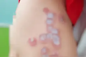 警惕！孩子皮肤溃烂，一经接触就会传染？家长：只是去了趟水上乐园图片
