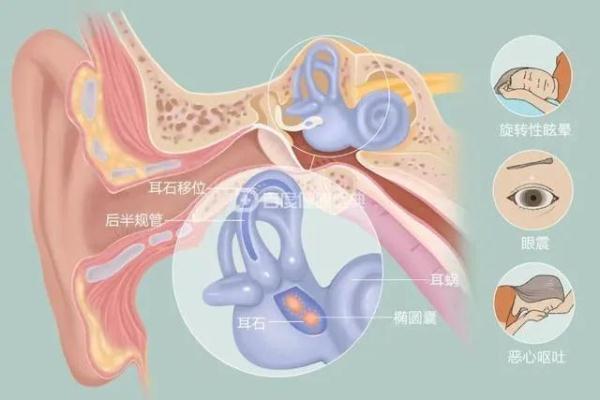 让人眩晕的“石头”——耳石症