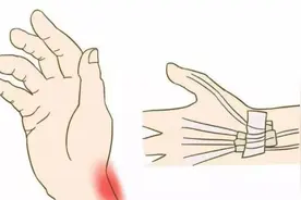 用手过多当心腱鞘炎 教你几个动作舒缓预防图片